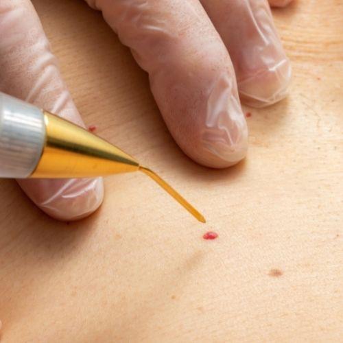 Skin Tags and Warts Removal Treatment